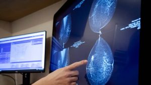 Yeni yapay zeka modeli 5 yıla kadarki göğüs kanseri riskini kestirim ediyor